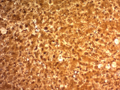 Formalin-fixed, paraffin-embedded human Hepatocellular Carcinoma stained with ARG1 Monoclonal Antibody (ARG1/1126).