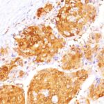 Formalin-fixed, paraffin-embedded human Hepatocellular Carcinoma stained with ARG1 Monoclonal Antibody (ARG1/1125 + ARG1/1126).