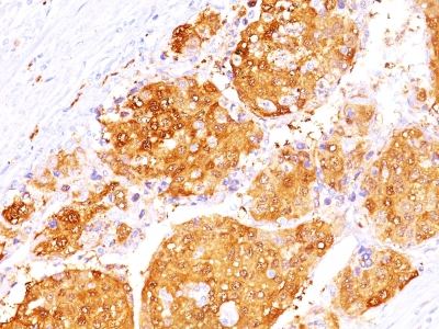 Formalin-fixed, paraffin-embedded human Hepatocellular Carcinoma stained with ARG1 Monoclonal Antibody (ARG1/1125 + ARG1/1126).
