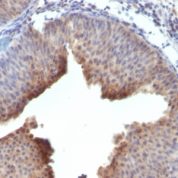 Formalin-fixed, paraffin-embedded human Bladder Carcinoma stained with Cytokeratin 6 Monoclonal Antibody (LHK6)