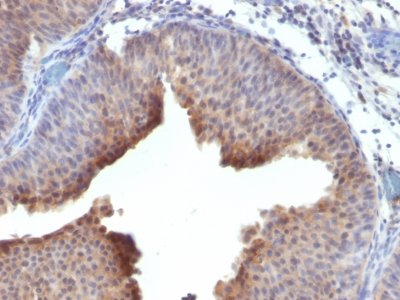 Formalin-fixed, paraffin-embedded human Bladder Carcinoma stained with Cytokeratin 6 Monoclonal Antibody (LHK6)