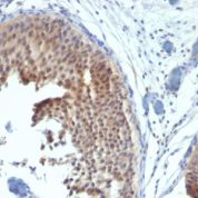 Formalin-fixed, paraffin-embedded human Bladder Carcinoma stained with Cytokeratin 6 Monoclonal Antibody (SPM269)