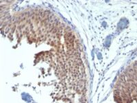 Formalin-fixed, paraffin-embedded human Bladder Carcinoma stained with Cytokeratin 6 Monoclonal Antibody (SPM269)