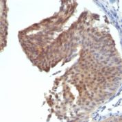 Formalin-fixed, paraffin-embedded human Bladder Carcinoma stained with Cytokeratin 6 Monoclonal Antibody (KRT6/172)