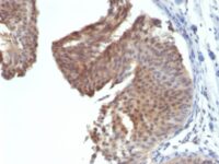 Formalin-fixed, paraffin-embedded human Bladder Carcinoma stained with Cytokeratin 6 Monoclonal Antibody (KRT6/172)