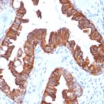 Formalin-fixed, paraffin-embedded human Endometrial Carcinoma stained with Cytokeratin-7 Recombinant Mouse Monoclonal Antibody (rOV-TL12/3).