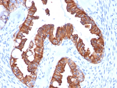 Formalin-fixed, paraffin-embedded human Endometrial Carcinoma stained with Cytokeratin-7 Recombinant Mouse Monoclonal Antibody (rOV-TL12/3).