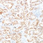 Formalin-fixed, paraffin-embedded human Lung SCC stained with Cytokeratin 7 Monoclonal Antibody (SPM27)