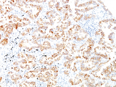 Formalin-fixed, paraffin-embedded human Lung SCC stained with Cytokeratin 7 Monoclonal Antibody (SPM27)