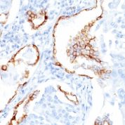 Formalin-fixed, paraffin-embedded Ovarian Carcinoma stained with Cytokeratin 7 Monoclonal Antibody (K72.7)