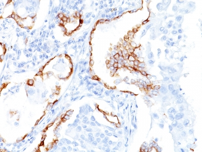 Formalin-fixed, paraffin-embedded Ovarian Carcinoma stained with Cytokeratin 7 Monoclonal Antibody (K72.7)