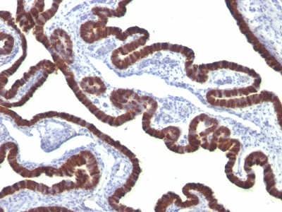 Formalin-fixed, paraffin-embedded human Lung Carcinoma stained with Cytokeratin 7 Monoclonal Antibody (KRT7/76)