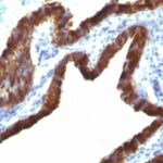 Formalin-fixed, paraffin-embedded human Lung Carcinoma stained with Cytokeratin 7 Monoclonal Antibody (KRT7/76 + OV-TL12/3)