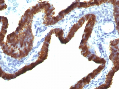 Formalin-fixed, paraffin-embedded human Lung Carcinoma stained with Cytokeratin 7 Monoclonal Antibody (KRT7/76 + OV-TL12/3)