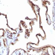 Formalin-fixed, paraffin-embedded human Ovarian Carcinoma stained with Cytokeratin 7 Monoclonal Antibody (KRT7/1198)