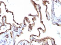 Formalin-fixed, paraffin-embedded human Ovarian Carcinoma stained with Cytokeratin 7 Monoclonal Antibody (KRT7/1198)