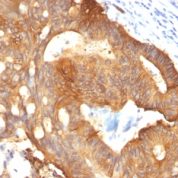 Formalin-fixed, paraffin-embedded Colon Carcinoma stained with Cytokeratin 8 Monoclonal Antibody (B22.1).