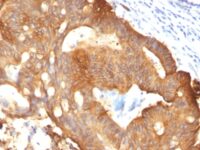 Formalin-fixed, paraffin-embedded Colon Carcinoma stained with Cytokeratin 8 Monoclonal Antibody (B22.1).