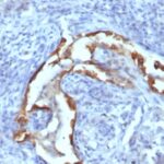 Formalin-fixed, paraffin-embedded human Lung Carcinoma stained with Cytokeratin 8 Monoclonal Antibody (SPM538).