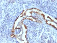 Formalin-fixed, paraffin-embedded human Lung Carcinoma stained with Cytokeratin 8 Monoclonal Antibody (SPM538).