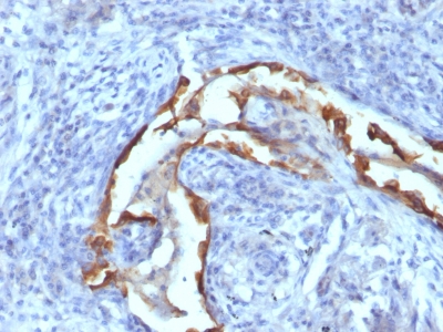 Formalin-fixed, paraffin-embedded human Lung Carcinoma stained with Cytokeratin 8 Monoclonal Antibody (SPM538).
