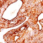 Formalin-fixed, paraffin-embedded human Colon Carcinoma stained with Cytokeratin 8 Monoclonal Antibody (TS1).