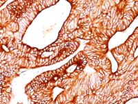 Formalin-fixed, paraffin-embedded human Colon Carcinoma stained with Cytokeratin 8 Monoclonal Antibody (TS1).