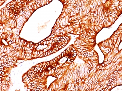 Formalin-fixed, paraffin-embedded human Colon Carcinoma stained with Cytokeratin 8 Monoclonal Antibody (TS1).