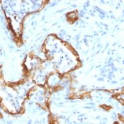 Formalin-fixed, paraffin-embedded human Lung Carcinoma stained with Cytokeratin 8 Monoclonal Antibody (SPM192).