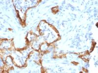 Formalin-fixed, paraffin-embedded human Lung Carcinoma stained with Cytokeratin 8 Monoclonal Antibody (SPM192).