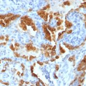 Formalin-fixed, paraffin-embedded Lung Carcinoma stained with Cytokeratin 8 Monoclonal Antibody (H1+TS1).