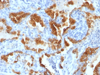 Formalin-fixed, paraffin-embedded Lung Carcinoma stained with Cytokeratin 8 Monoclonal Antibody (H1+TS1).