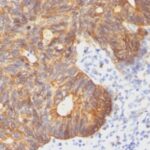 Formalin-fixed, paraffin-embedded human Colon carcinoma stained with Cytokeratin 8 Monoclonal Antibody (C-43).