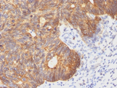 Formalin-fixed, paraffin-embedded human Colon carcinoma stained with Cytokeratin 8 Monoclonal Antibody (C-43).