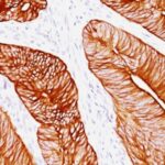 Formalin-fixed, paraffin-embedded human Colon Carcinoma stained with Cytokeratin 8 Monoclonal Antibody (K8.8).