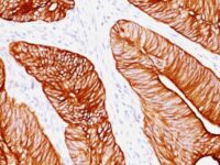 Formalin-fixed, paraffin-embedded human Colon Carcinoma stained with Cytokeratin 8 Monoclonal Antibody (K8.8).