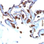 Formalin-fixed, paraffin-embedded human Lung Carcinoma stained with Cytokeratin 8 Monoclonal Antibody (KRT8/83).