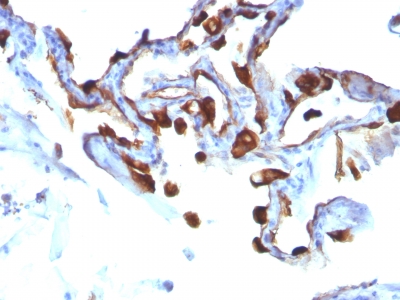 Formalin-fixed, paraffin-embedded human Lung Carcinoma stained with Cytokeratin 8 Monoclonal Antibody (KRT8/83).