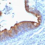 Formalin-fixed, paraffin-embedded human Lung Carcinoma stained with Cytokeratin 8 Monoclonal Antibody (KRT8/899).