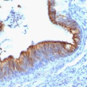 Formalin-fixed, paraffin-embedded human Lung Carcinoma stained with Cytokeratin 8 Monoclonal Antibody (KRT8/899).