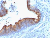 Formalin-fixed, paraffin-embedded human Lung Carcinoma stained with Cytokeratin 8 Monoclonal Antibody (KRT8/899).