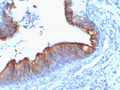 Formalin-fixed, paraffin-embedded human Lung Carcinoma stained with Cytokeratin 8 Monoclonal Antibody (KRT8/899).