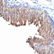 Formalin-fixed, paraffin-embedded human Bladder Carcinoma stained with Cytokeratin 1 Monoclonal Antibody (LH2).