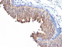 Formalin-fixed, paraffin-embedded human Bladder Carcinoma stained with Cytokeratin 1 Monoclonal Antibody (LH2).