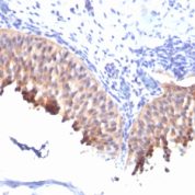 Formalin-fixed, paraffin-embedded human Bladder Carcinoma stained with Cytokeratin 1 Monoclonal Antibody (SPM261).