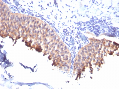 Formalin-fixed, paraffin-embedded human Bladder Carcinoma stained with Cytokeratin 1 Monoclonal Antibody (SPM261).