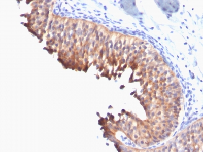Formalin-fixed, paraffin-embedded human Bladder Carcinoma stained with Cytokeratin 1 Monoclonal Antibody (DE-K1).