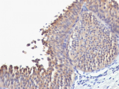 Formalin-fixed, paraffin-embedded human Bladder Carcinoma stained with Cytokeratin 1 Monoclonal Antibody (SPM623).