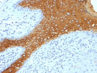 Formalin-fixed, paraffin-embedded human Skin stained with Cytokeratin 1 Monoclonal Antibody (KRT1/+ KRT1/1275).