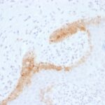 Formalin-fixed, paraffin-embedded human Basal Cell Carcinoma stained with Cytokeratin 15 Monoclonal Antibody (KRT15/1699).